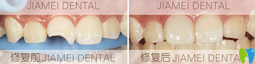 佳美口腔牙齒修復案例
