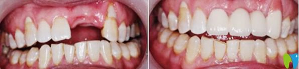 <!--<i data=20240703-sp></i>-->美奧牙齒種植效果案例