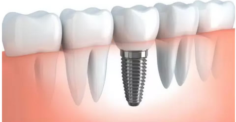 深圳韋博口腔科普 種植牙價(jià)格及哪些因素會(huì)影響種植牙壽命
