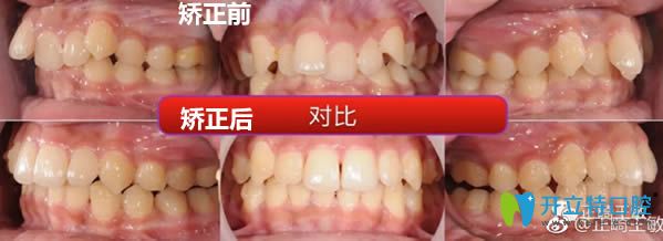 北京瑞泰口腔<!--<i data=20240703-sp></i>-->牙齒擁擠矯正前后對(duì)比照