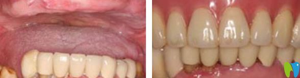 深圳韋博口腔半口牙缺失種植效果案例