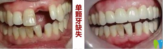 北京瑞泰口腔單顆牙科缺失種植前后對比效果 北京瑞泰口腔單顆牙科缺失種植前后對比效果