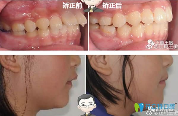 北京瑞泰<!--<i data=20240703-sp></i>-->醫(yī)生下巴后縮矯正前后對(duì)比效果