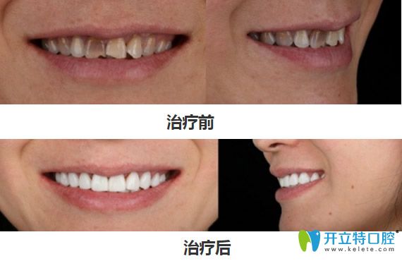 深圳弘和口腔四環(huán)素貼面修復(fù)案例對比圖