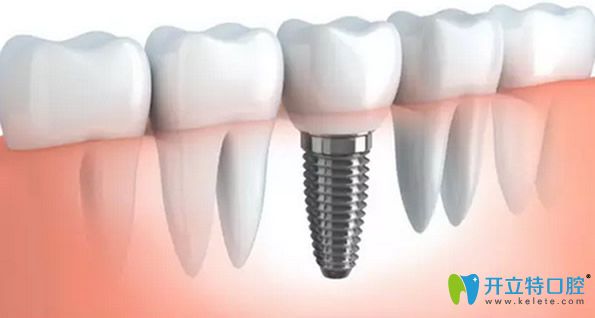 種植牙美觀自然咀嚼功能好