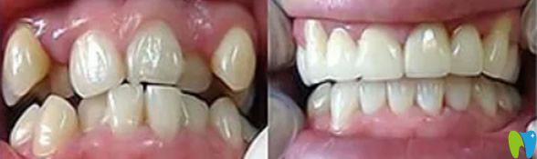 深圳韋博口腔矯正牙齒前后效果對(duì)比圖
