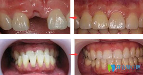 麥芽口腔單顆牙缺失種植+牙齒矯正效果案例 麥芽口腔單顆牙缺失種植+牙齒矯正效果案例