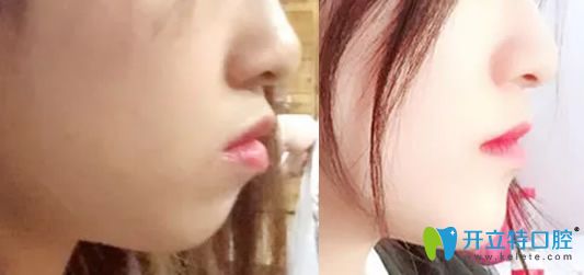 牙齒矯正能改變臉行嗎？看佳美口腔牙齒矯正前后對比照片知
