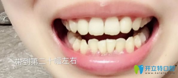 瑞德口腔矯正牙齒14個(gè)月恢復(fù)效果
