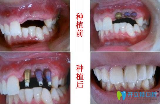 <!--<i data=20240703-sp></i>-->圣貝王申院長(zhǎng)多顆牙缺失即刻種植前后對(duì)比照