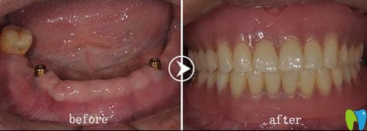 <!--<i data=20240703-sp></i>-->圣貝王申醫(yī)生全口all on 4種植牙前后對(duì)比效果