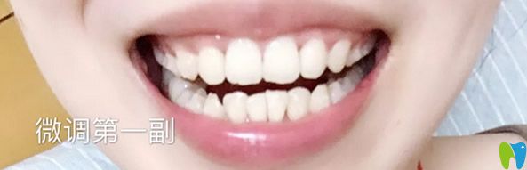 矯正牙齒后要帶牙齒保持器