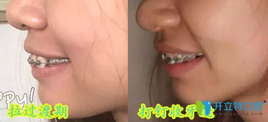 深圳弘和口腔齙牙齒矯正過渡期