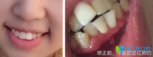 惠州麥芽口腔隱形矯正牙齒前