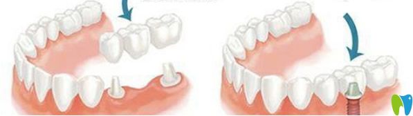 修復缺失牙的方法有鑲牙烤瓷牙種植牙