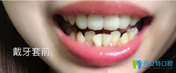 廣州瑞德口腔牙齒矯正前