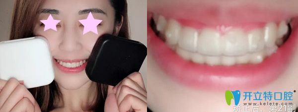 戴21副隱形牙套時(shí)的矯正效果