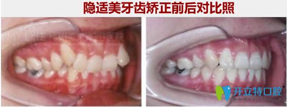 隱適美隱形矯正前后對比照