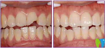 牙齒碎了一小塊怎么辦還會(huì)長(zhǎng)嗎 能補(bǔ)嗎 答案都在這里