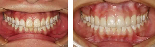 氟斑牙怎么美白 佛山華美口腔瓷貼面修復(fù)很管用 但價(jià)格稍貴