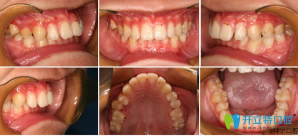 <!--<i data=20240703-sp></i>-->拜博口腔矯正牙齒前