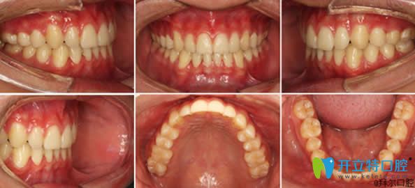 <!--<i data=20240703-sp></i>-->拜博口腔牙齒矯正2年后的恢復(fù)效果