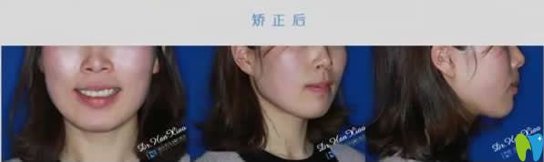 科瓦口腔隱形矯正牙齒18個(gè)月的效果
