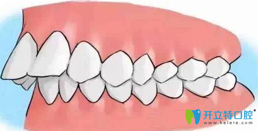 修復(fù)齙牙多少錢？齙牙矯正方法及價(jià)格表分享