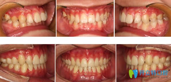 矯正牙齒前后效果對比案例
