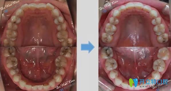 <!--<i data=20240703-sp></i>-->科瓦齒科正畸前后效果對比圖