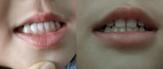 3歲女兒在西安雁塔惟真口腔矯正“地包天”30天來(lái)的記錄