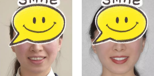 上海美樂口腔矯正牙齒怎么樣 25歲正畸案例+前后對比照見證