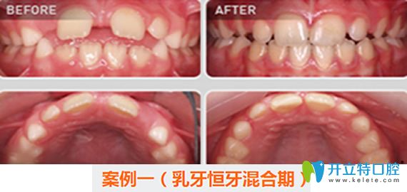 <!--<i data=20240703-sp></i>-->口腔兒童牙齒矯正案例對(duì)比圖