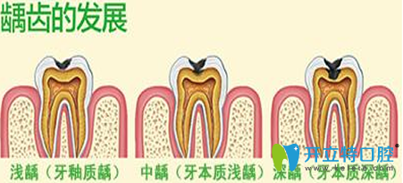 兒童齲齒怎么治療多少錢？齲齒治療預(yù)防方法及費(fèi)用大全