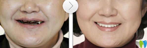 老年人全口牙種植前后對比<span style=
