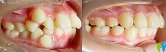 科爾口腔牙齒矯正前后效果