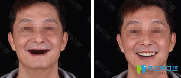 <!--<i data=20240703-sp></i>-->維樂口腔種植牙效果案例