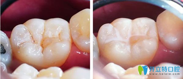 <!--<i data=20240703-sp></i>-->維樂口腔根管治療齲齒補牙后效果