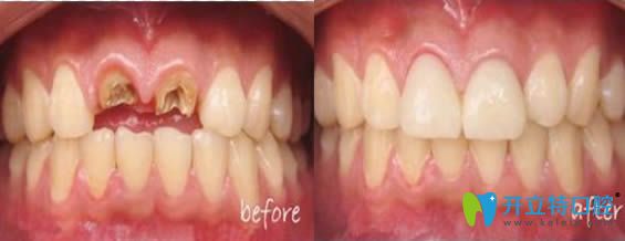 鄭州卓越口腔種植牙案例效果對(duì)比圖