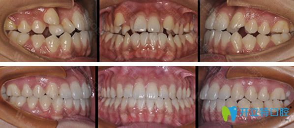 維樂口腔因金屬托槽矯正牙齒前后效果對比照