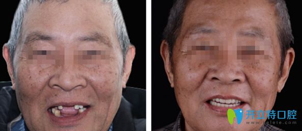 維樂口腔全口牙缺失種植效果案例