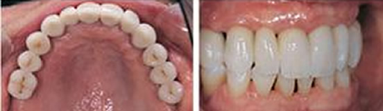 ?趁重慶維樂口腔價(jià)格優(yōu)惠 帶半口牙缺失的媽媽做了種植牙