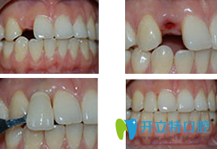 寧波恩吉口腔種植牙齒費(fèi)用便宜效果還好,顧客體驗(yàn)后的評(píng)價(jià)