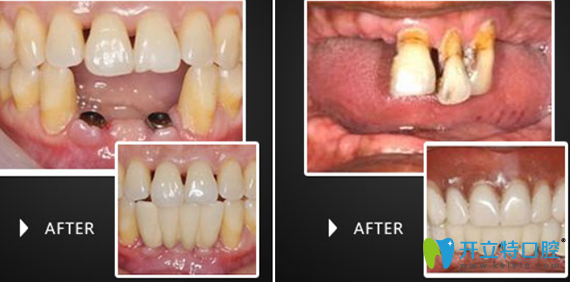 、淮安牙科哪家好點？看牙知道（三淮）口腔牙齒種植案例知