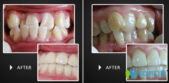 淮安評價好的口腔是哪家？牙知道口腔牙齒矯正治療效果來驗證