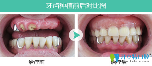 寧波恩吉口腔牛伊南種植牙<span style=