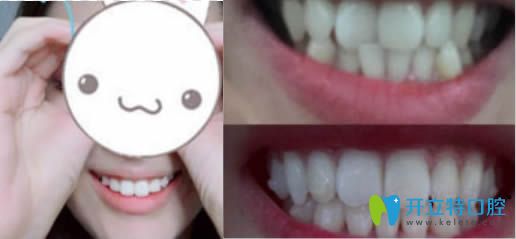 <!--<i data=20240703-sp></i>-->永華齒科牙齒正畸效果對比照