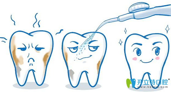 洗牙多少錢？多久洗牙一次比較好？淮安牙知道醫(yī)生揭秘