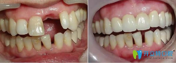 <!--<i data=20240703-sp></i>-->維佳康口腔吳鳳霞醫(yī)生單顆牙缺失種植前后對(duì)比效果