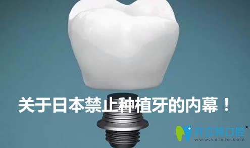 內(nèi)幕！日本為什么停止種植牙？禁止種植牙是真的嗎？